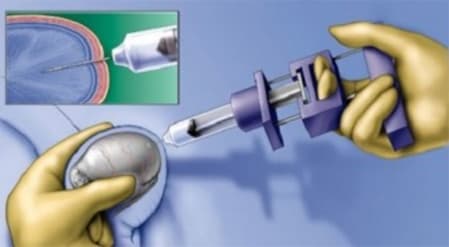 MALE INFERTILITY image 4