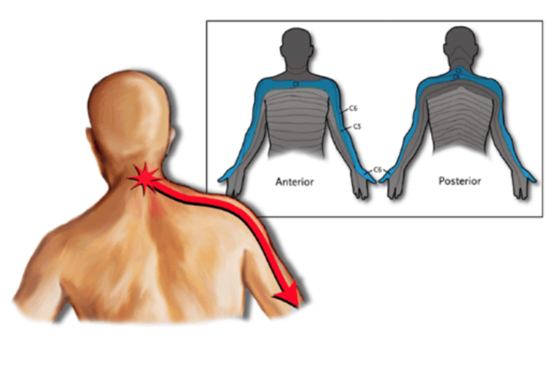 Cervical Radicular Syndrome (HNP)