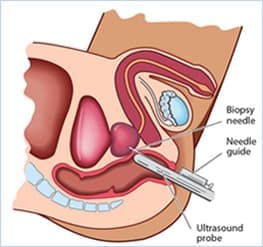 Prostate cancer image 3