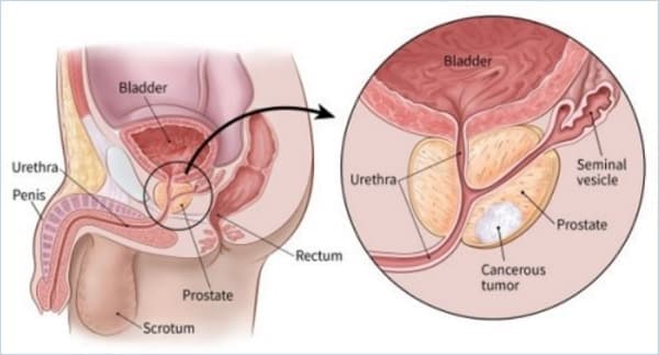Prostate cancer image